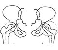 Variants of acetabular structure and types of dysplastic decentration  of the femoral head in the frontal plane