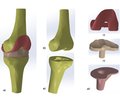 Biomechanical analysis of conditions of the functioning of knee endoprosthesis  in varus deformities in patients with rheumatoid arthritis