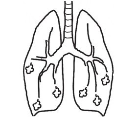 Роль механизмов антиоксидантной системы  в развитии заболеваний органов дыхания