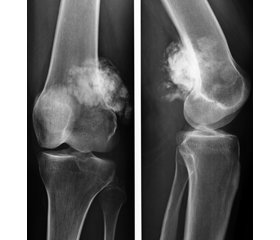 Оцінка ефективності та ускладнень неоад’ювантної поліхіміотерапії  у комбінованому лікуванні хворих  на остеосаркому довгих трубчастих кісток