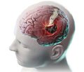 Epidemiology of traumatic brain injury in the Republic of Belarus
