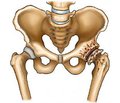 Rehabilitation activities in patients at the early stages of coxarthrosis after arthroscopy of the hip joint