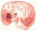 Медотилин в лечении постинсультных когнитивных нарушений