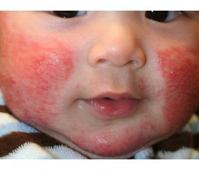 Оптимізація лікування атопічного дерматиту  в дітей раннього віку із застосуванням урсодеоксихолевої кислоти