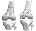 Analysis of the distribution of internal stresses and relative deformations in bone and extrafocal osteosynthesis in distal femoral metaphysis fractures