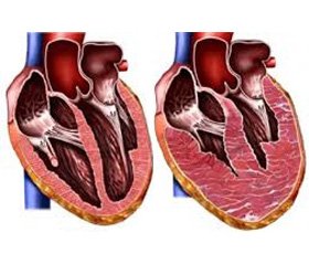 Удосконалення діагностики діастолічної дисфункції шлуночків серця в новонароджених  за даними тканинної допплерометрії