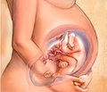 State of the system placenta-fetus-newborn at the pregnant with disorder of microbiocoenosis of sex ways