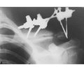 Case of chronic osteomyelitis of the clavicle with hyperostosis reaction in a fracture
