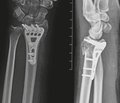 Fixation of AO 23-C severe radius fractures using volar plate. Analysis of the causes of treatment complications