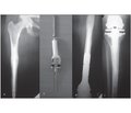 Осложнения после эндопротезирования коленного сустава при использовании индивидуальных онкологических эндопротезов у больных с опухолями костей