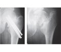 Fixator and bone plastics in femoral neck fractures treatment and pseudoarthrosis