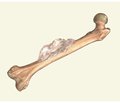 Principles of rehabilitation of patients with bone tumors (modern view of the problem)