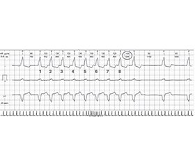 Діагностика й особливості лікування пейсмейкерної тахікардії