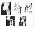 Reconstructive and regenerative surgeries of the hip joint. The role and importance of the works of professor M.I. Kulish in its development