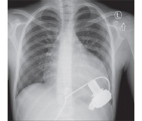 Experience of personalized treatment of pediatric patients with implanted left ventricular assist devices in the early postoperative period