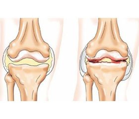 Osteoathritis of large joints in the patients with diabetes mellitus