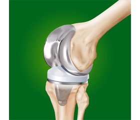 Лечение нагноений области эндопротезирования коленного сустава