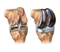 Indications and Contraindications for Arthroplasty of Tumor Defects of the Knee Joint Bones