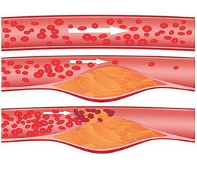 Structural and functional state of bone and fracture risk in patients with atherosclerosis of coronary vessels