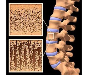 Using of Lovastatin Nanoparticles for the Osteoporosis Treatment and Fracture Risk Reduction (Experimental Study)