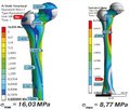 Comparative analysis of the reliability of the fixation of pertrochanteric fractures using normal and elongated proximal femoral nail