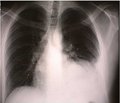 Complicated pneumococcal pneumonia in a child: case report.