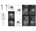 Current experience of using SPECT/CT in patients with bone pathology (literature review)