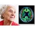 Судинна деменція: механізми розвитку та можливості запобігання
