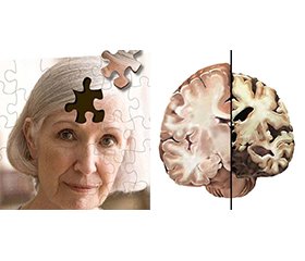 Стратегія послідовної фармакопрофілактики та фармакотерапії синдрому помірних когнітивних розладів та ранніх стадій деменції