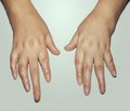The onset  and evolution characters of juvenile rheumatoid arthritis symptomatology during in the first year of its  development.