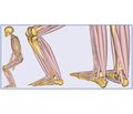 Влияние смещения периферического фрагмента пяточной кости при ее переломе на функцию трехглавой мышцы голени