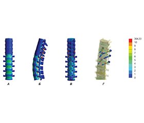 Напружено-деформований стан моделі грудопоперекового відділу хребта з переломом хребця Th12 типу A1 за короткої транспедикулярної фіксації: аналіз компресійного навантаження