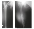 Total hip replacement for complications of osteosynthesis of the femoral neck in the regional center of endoprosthesis replacement of large joints based on RHIT in Mariupol