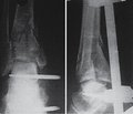 Discussion questions in surgical treatment of pilon fractures