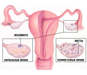 Функциональное состояние оси  «гипофиз — ​гонады» у женщин  с синдромом поликистозных яичников