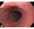 Lifestyle modification in the treatment of refractory gastroesophageal reflux disease and non-alcoholic fatty liver disease. A clinical case