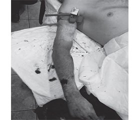 Оцінка ефективності та ризиків застосування турнікетів у ЗСУ під час бойових дій в Україні