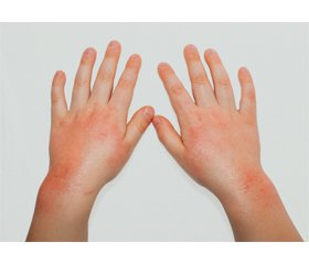 Роль мікробіому шкіри в розвитку атопічного дерматиту у дітей