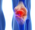Comprehensive physical rehabilitation of patients with dysplastic deformities of the knee joint