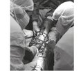 Complex approach in the treatment of patients with false joints of the tibia
