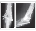 Clinical results of the olecranon fracture treatment using intramedullary fixation