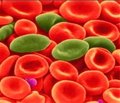 Заболеваемость серповидно-клеточной анемией к 2050 году возрастет на треть