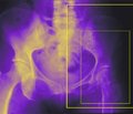 Аналіз результатів оперативного лікування субкапітальних та трансцервікальних переломів шийки стегнової кістки пучком спиць з різьбою та пластиною DHS