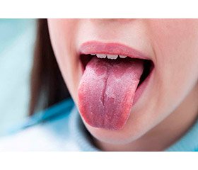 Клінічні стани: печіння порожнини рота.  Що може зруйнувати бездоганну роботу стоматолога — глосодинія чи непереносимість сплавів та матеріалів?