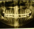 Клиническая классификация переломов мыщелкового отростка нижней челюсти