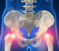 Міні-інвазійне лікування переломів проксимального відділу стегна у хворих із поєднаною травмою