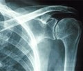 Клиническая диагностика нестабильности плечевого сустава у лиц, перенесших травматический вывих плеча